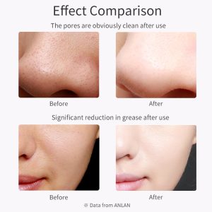 ANLAN Ultrasonic Skin Scrubber Deep Face Cleaning Machine Peeling Shovel Facial Pore Cleaner Face Skin Scrubber Lift Machine